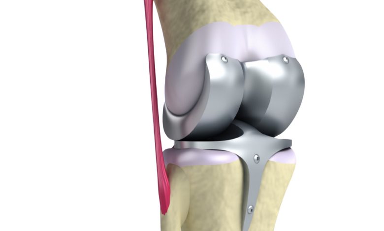 Prótese total de joelho quando esse tratamento é indicado