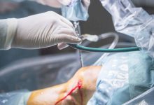 Sutura do menisco quando ela é indicada